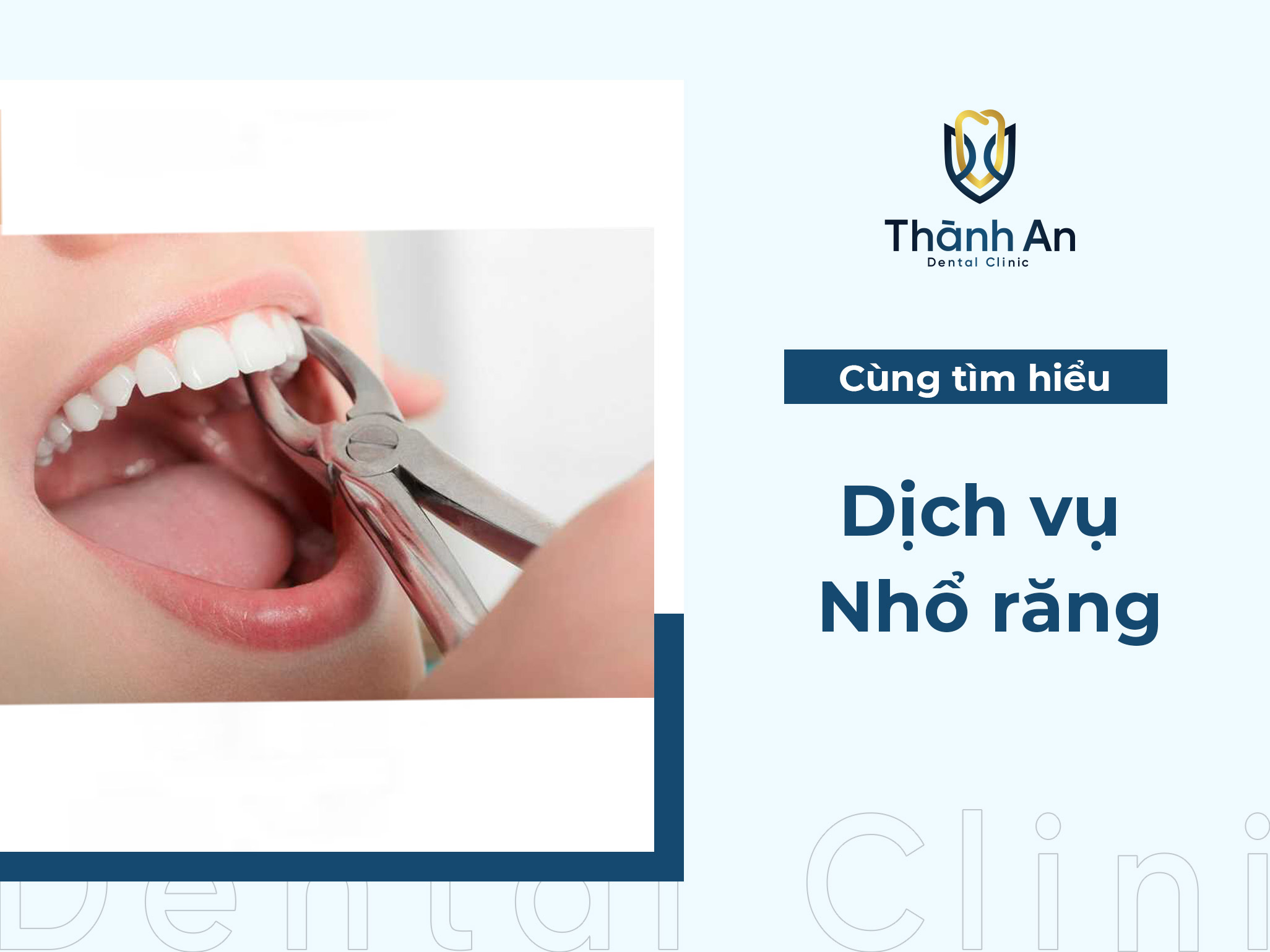 Dịch vụ nhổ răng