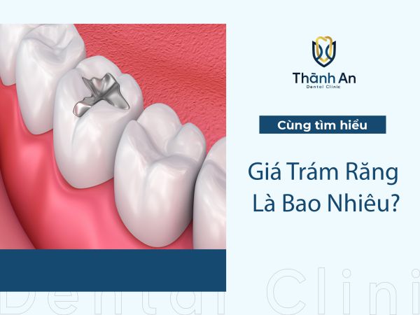Giá Trám Răng Là Bao Nhiêu? Khi Nào Cần Hàn Răng?