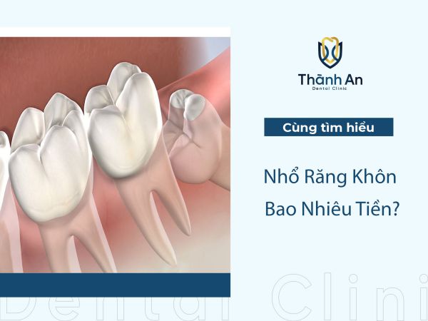 Nhổ Răng Khôn Bao Nhiêu Tiền? Báo Giá Và Tư Vấn Tốt Nhất