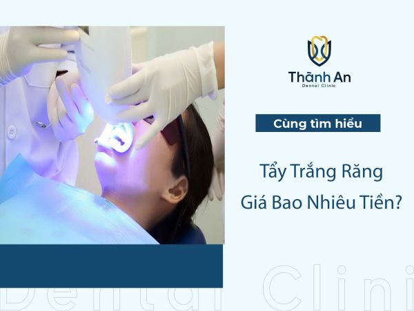 Tẩy trắng răng giá bao nhiêu? Tẩy Trắng Răng Bao Nhiêu Lần Để Hiệu Quả?