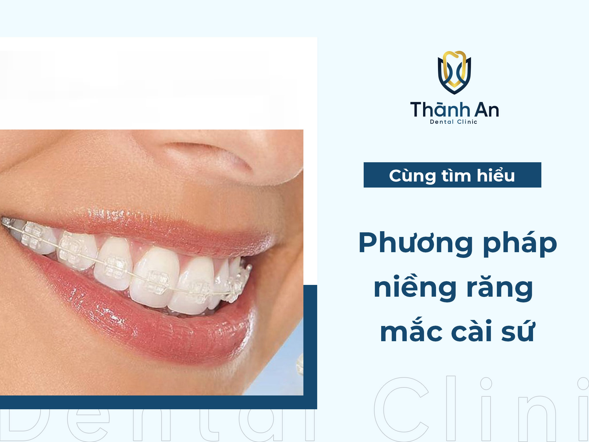 Niềng Răng Mắc Cài Sứ Giá Bao Nhiêu? Loại Nào Tốt Nhất?