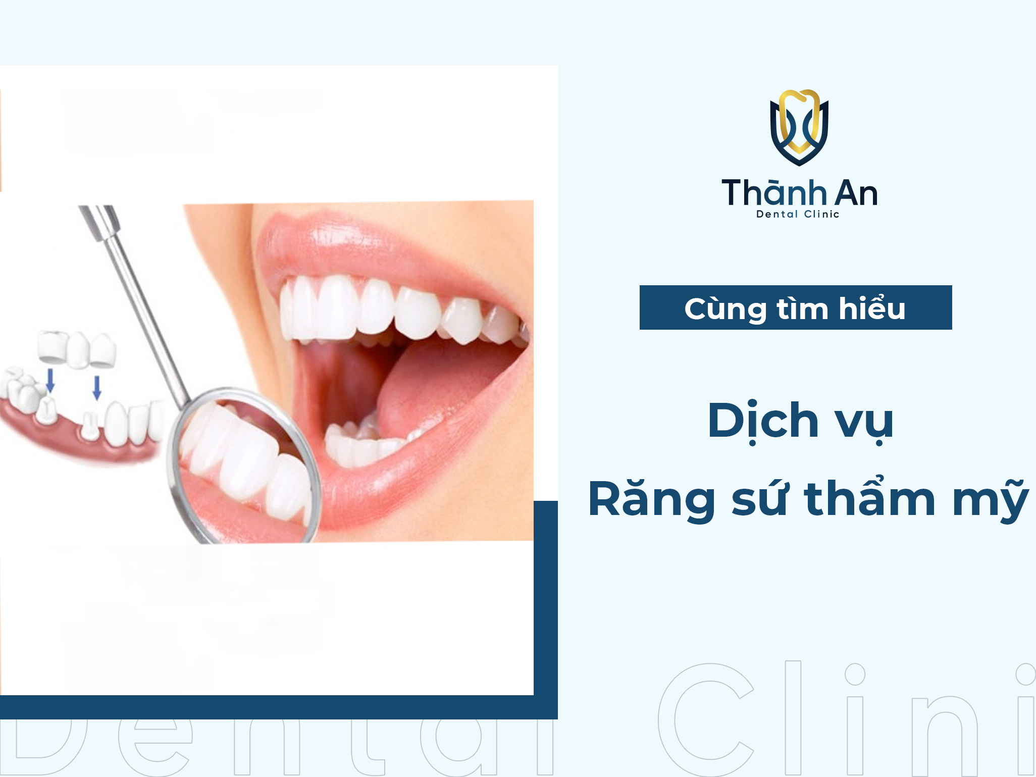 Răng sứ thẩm mỹ